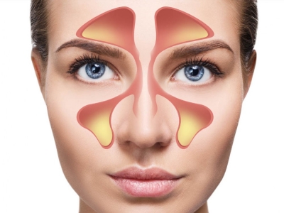 Nieżyt nosa (katar) i nieżyt zatok przynosowych