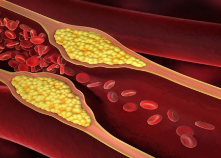 Przewlekłe niedokrwienie kończyn dolnych