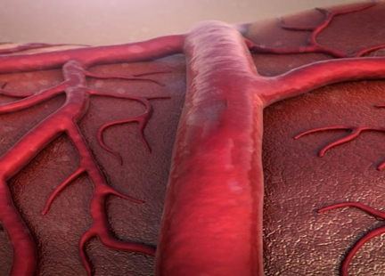 Zakrzepica żył głębokich