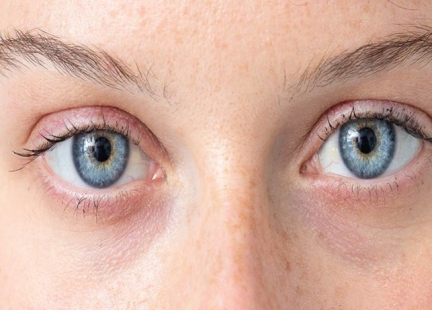 Zespół Marfana – choroba genetyczna tkanki łącznej