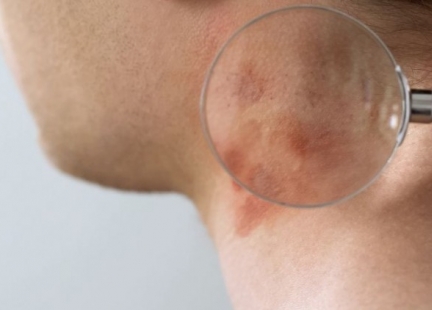 ŁUSZCZYCA – krępujący problem