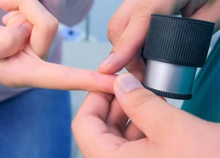 Kurzajki – naturalne metody leczenia