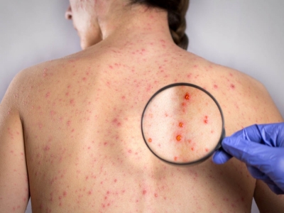 Mononukleoza zakaźna