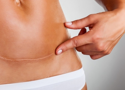 Jak pomóc w regeneracji ran pooperacyjnych